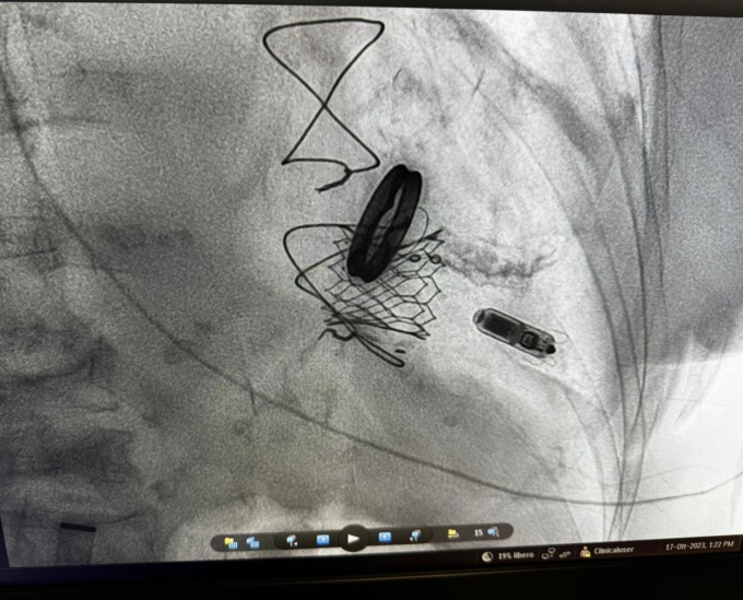 82enne con gravi problemi di cuore salvata da un innovativo pacemaker senza fili