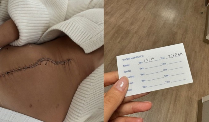 Bianca Balti mostra la cicatrice dopo l’intervento per rimuovere il tumore ovarico: “Ora posso iniziare a fare progetti”